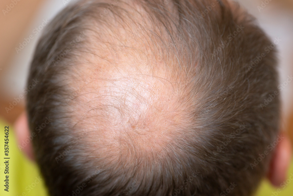 Hair losing concept. Close up view of a man's head. Hair losing concept. Close up view of a man's head.