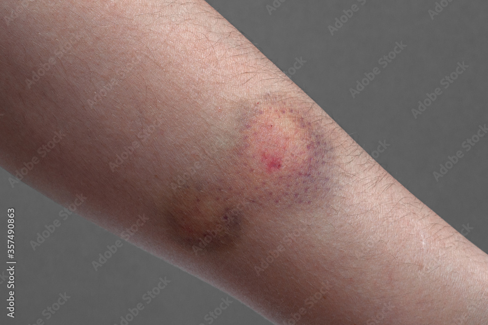 Fototapeta premium Close up of a colored bruise on a woman arm