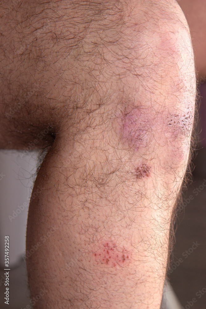 Fototapeta premium bruise and bruise on a man knee.