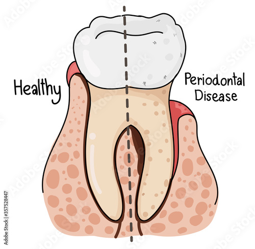 Heathy and Periodontal Disease Teeth Anatomy.