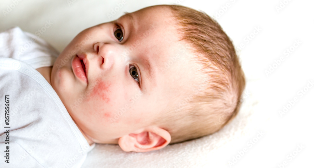 Foto de Atopic dermatitis eczema in baby.Condition that causes the skin