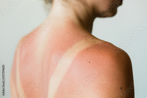Close-up of a sunburn marks on a woman's back photo