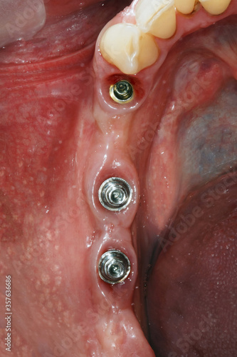 oral mucosa and multiunits after implantation for prosthetics of a bridge or a small prosthesis