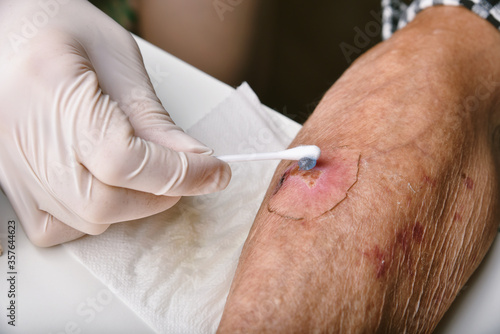 Wound dressing, Doctor applying medicine to infected wound in chronic diabetes senior patient, Accidental wound care treatment in elderly old man.