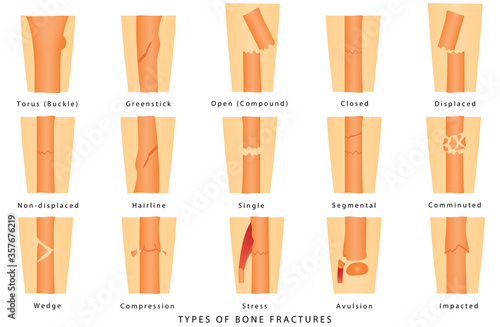 Types of fracture. Human Broken Bone. Different types of bone fractures. Types of bone fractures medical skeleton anatomy educational vector illustration about injury and disease on white background