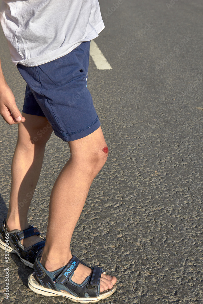 bruised wound on the knee, the boy fell and scratched his knee