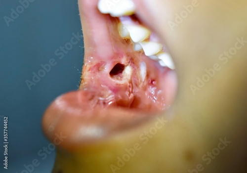 Small wound in buccal area due to injury in Asian, child.