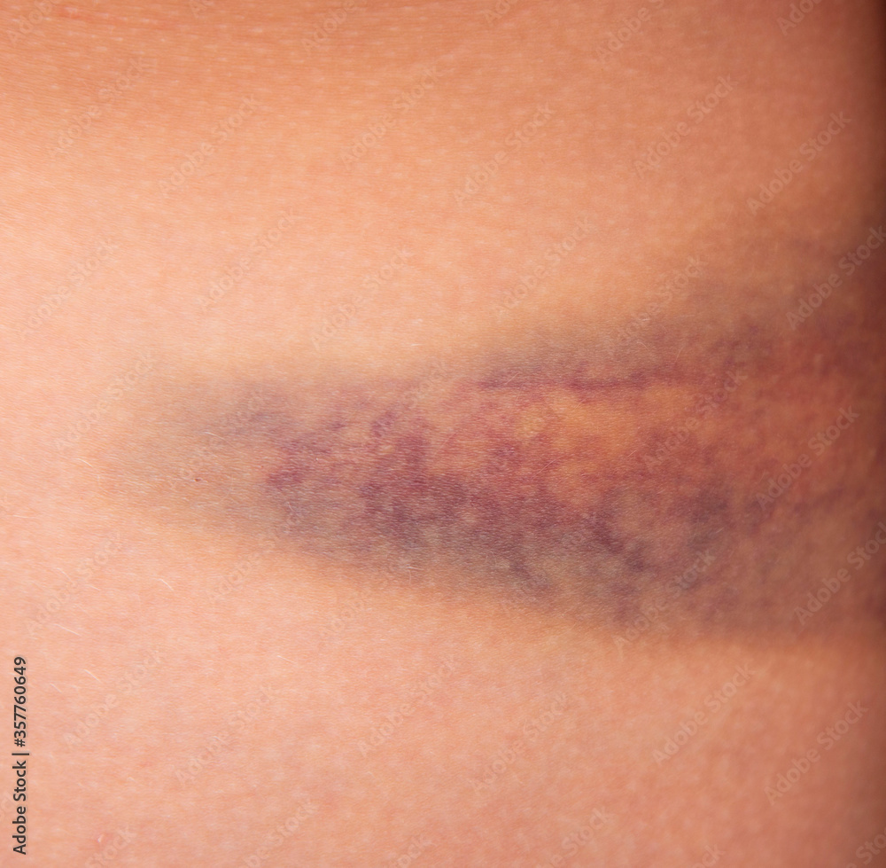 large bruise on the skin on the leg