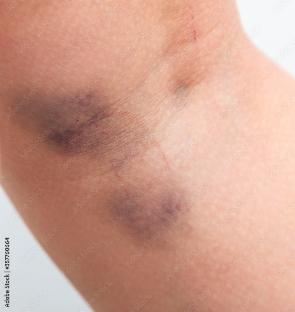 large bruise on the skin on the leg large bruise on the skin on the leg