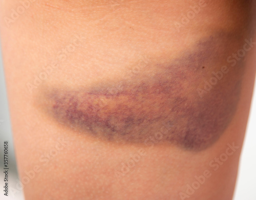 Foto large bruise on the skin on the leg