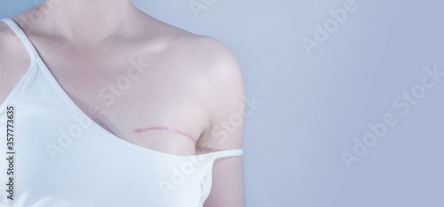 Breast cancer surgery scars by partial mastectomy.  She can wear a tube top or tube dress and strapless with confident. With effect filter.