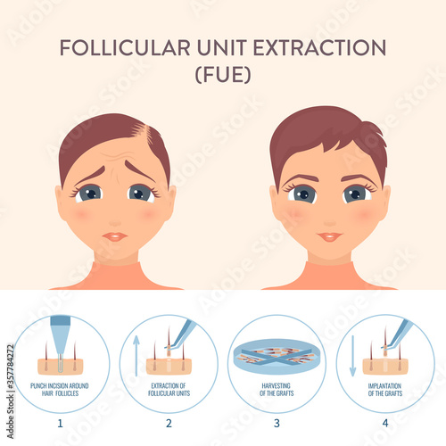 Hair transplant alopecia treatment by FUE. Stages of follicular unit extraction restoration surgery for women. Health care and medical concept. Vector illustration.