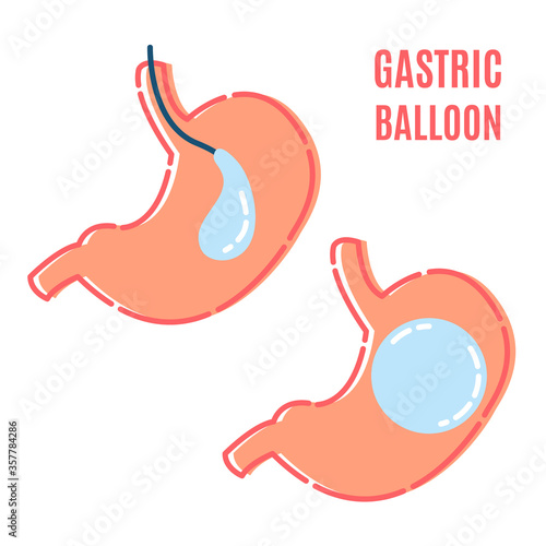 Gastric balloon non surgical weight loss procedure in stomach. Medical concept. Human body organ anatomy and health care. Vector illustration in flat style.