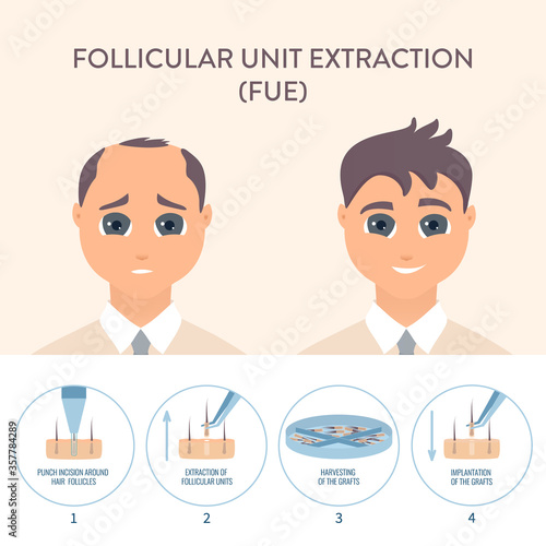 Hair transplant alopecia treatment by FUE. Stages of follicular unit extraction restoration surgery for men. Health care and medical concept. Vector illustration.