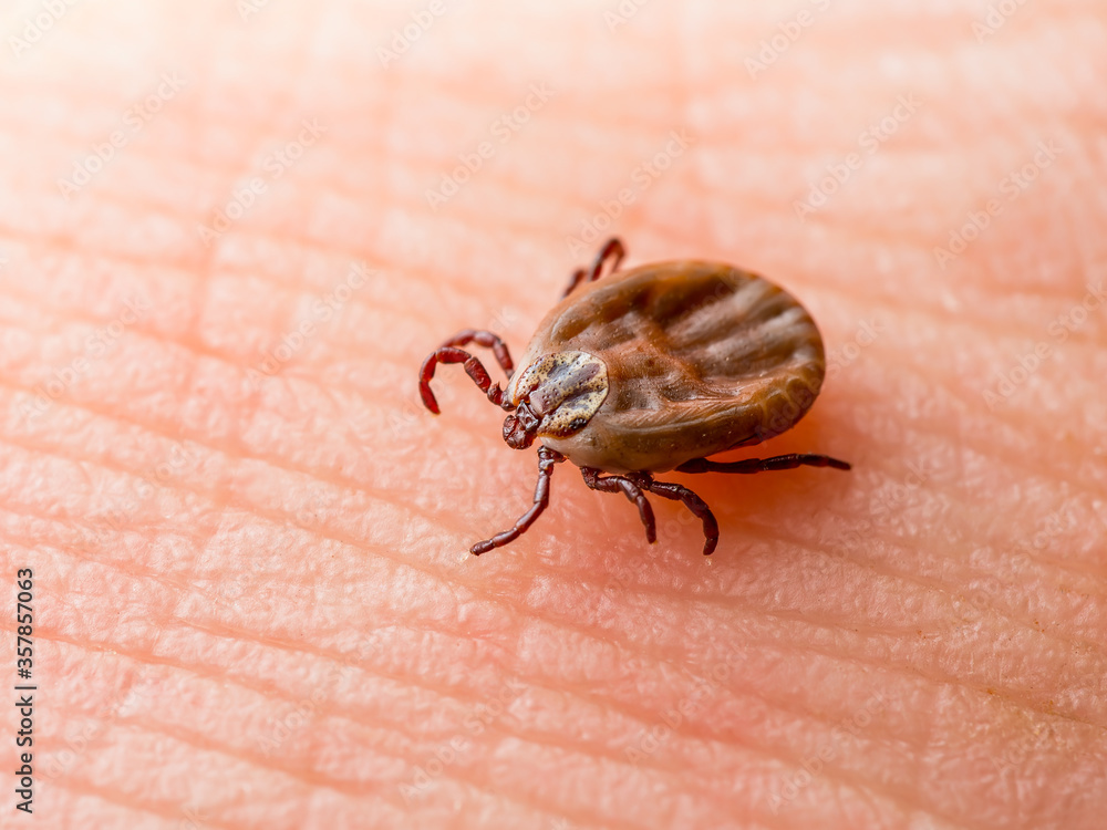 Foto De Lyme Disease Infected Tick Insect Crawling On Skin