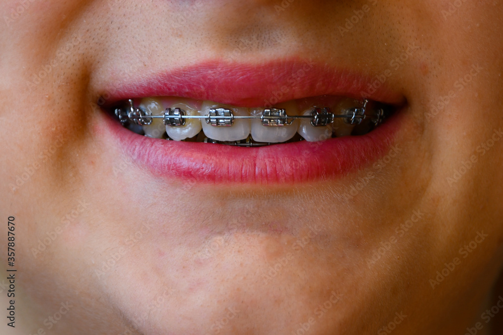 Naklejka premium A teenager smiling with fixed dental device