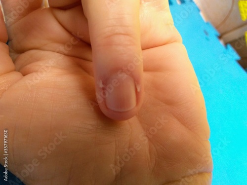 cuticle on finger