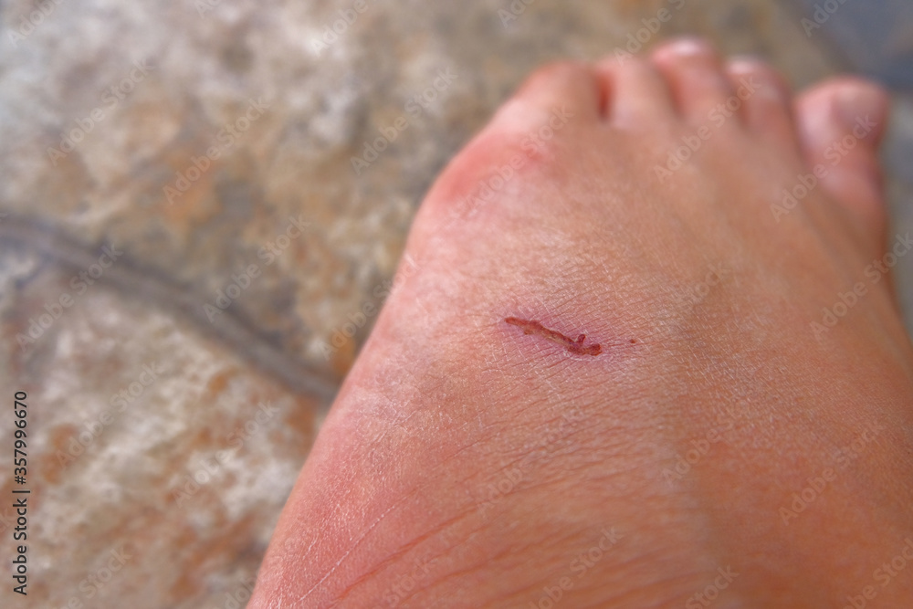 Fototapeta premium Close up wound on left foot. The scratch on foot.