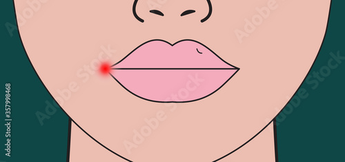 Herpes on lip. Red inflammation on lip of woman