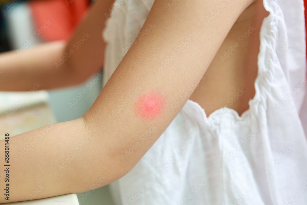 Obraz premium Little girl has skin rash and allergy from mosquito bite