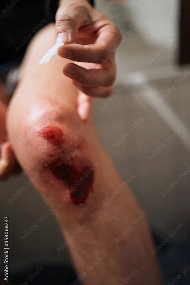 Fototapeta premium Scratched knee after accident, open wound with blood 