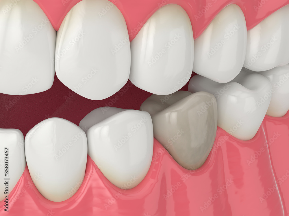 3d render of jaw and tooth with dead pulp 3d render of jaw and tooth with dead pulp
