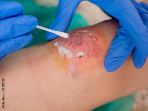 Close-up, treatment of an abrasion on the knee of a teenage girl by a doctor.