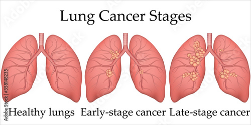 Vector medical illustration of human lung cancer development process. Stages of lung cancer from healthy lungs to the last stage. Poster for hospital or biology textbook.