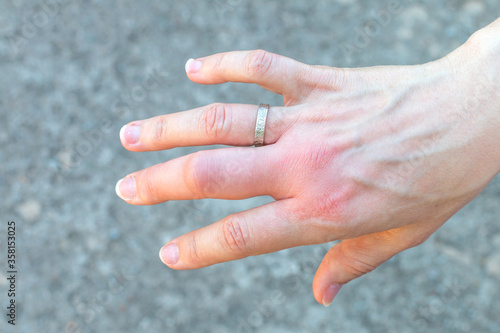 right hand with a swollen large middle finger after a bee bite with a wedding ring, enlarged in size due to allergy reaction after a wasp sting, red sensation on palm, finger wounded, skin irritation