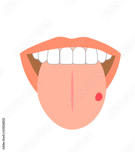 Illustration of tongue symptoms and health