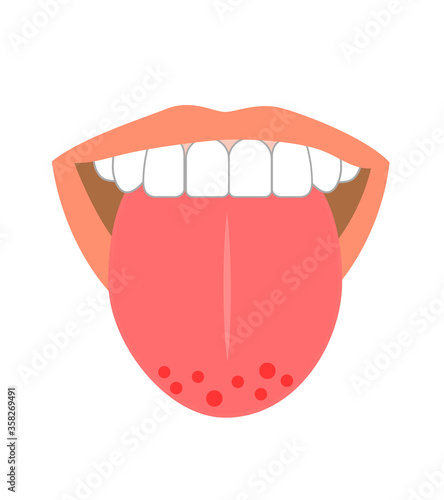 Illustration of tongue symptoms and health