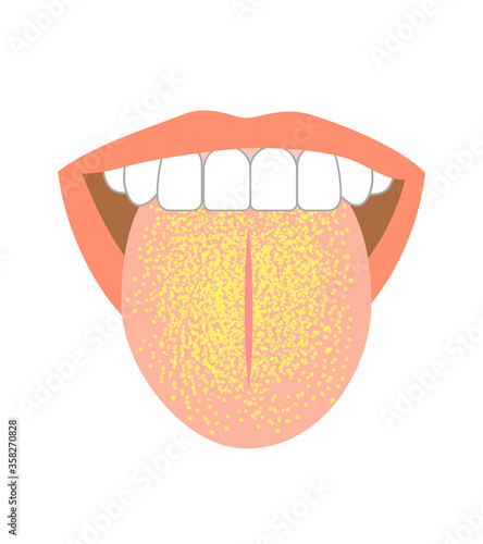 Illustration of tongue symptoms and health