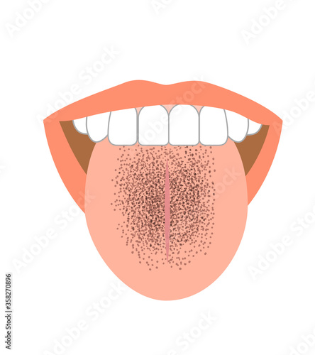 Illustration of tongue symptoms and health