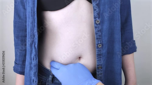 A woman suffers from pain in the appendix. Acute appendicitis, Crohn's disease, or inflammatory bowel disease. Surgeon examination and preparation for laparoscopic appendectomy