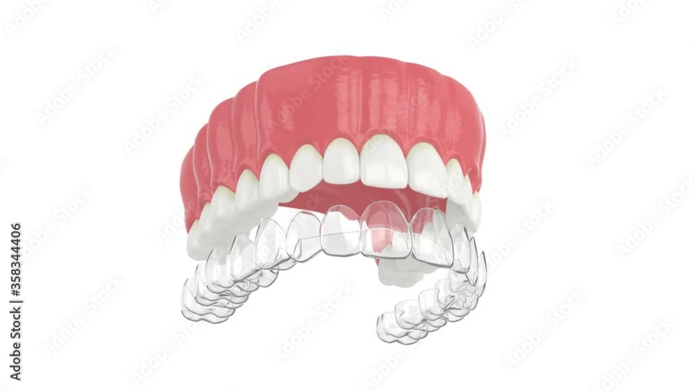 Invisalign removable and invisible retainer placement on upper jaw over white background Invisalign removable and invisible retainer placement on upper jaw over white background