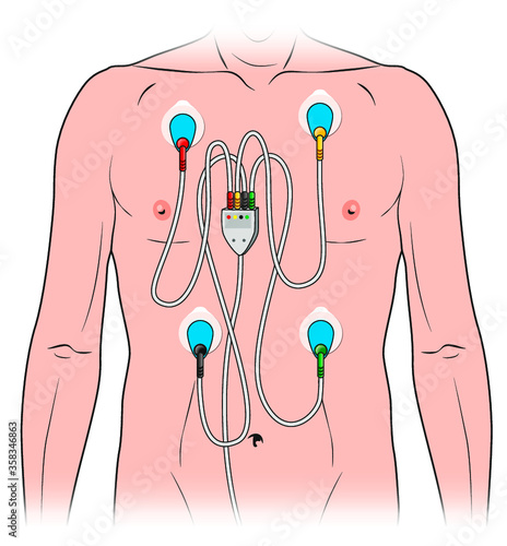 Derivaciones monitor electrocardiograma - enfermería