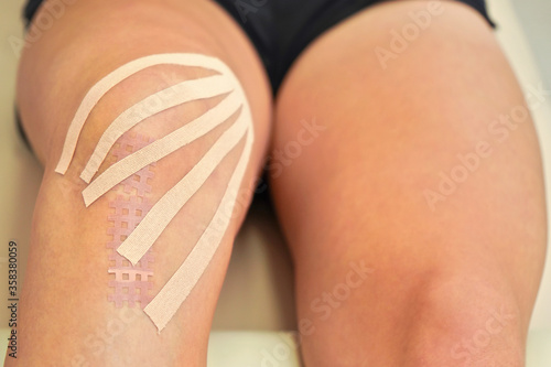 Kinesiology tape in body color cut to thin stripes applied to knee of female patient, closeup detail