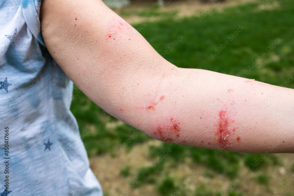 poison oak and poison ivy rash reaction, painful blisters and itchiness