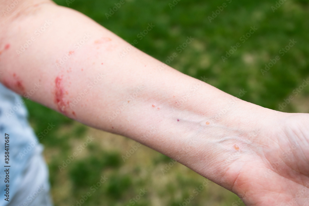 Poison ivy rash and reaction Stock Photo Adobe Stock