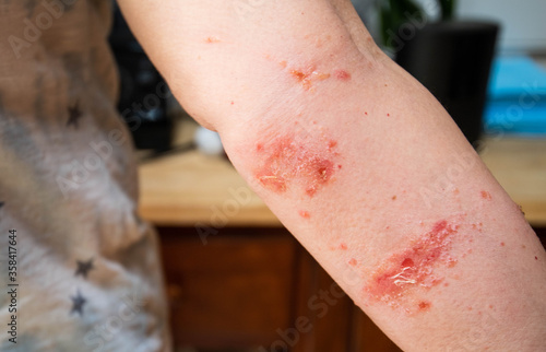 painful poison ivy rash and blisters photo