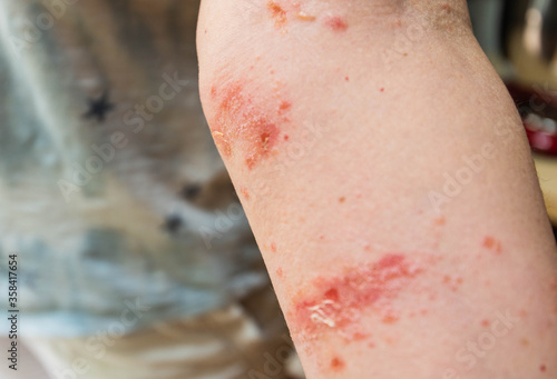 Photography painful poison ivy rash and blisters