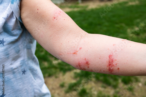 Photography poison oak and poison ivy rash reaction, painful blisters and itchiness
