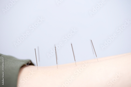 acupuncture needles back pain