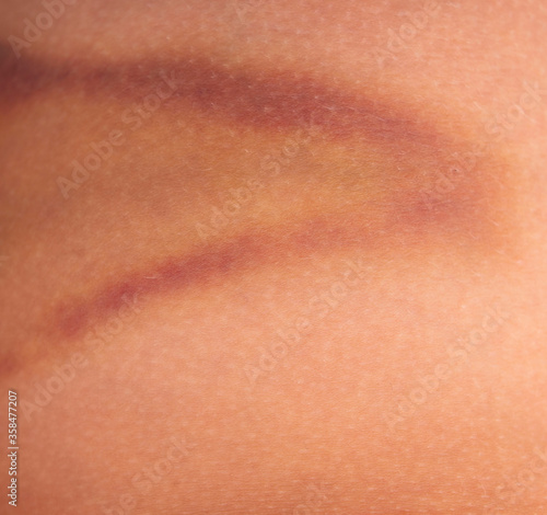 bruise on the skin as a background