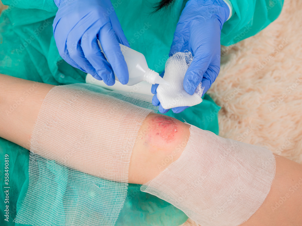 A Female Doctor Treats An Antiseptic Bandage For Dressing A Wound On a-female-doctor-treats-an-antiseptic-bandage-for-dressing-a-wound-on