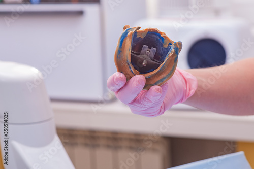 Dental prosthesis, dentures. Prosthetics work photo