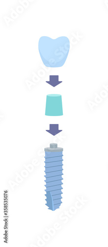 The dental scheme with arrows as a crown is installed on the abutment, and then on the dental implant. vector illustration, in a flat style with a thin line.Inside the oral cavity, the gums, the roots