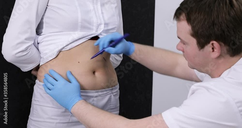 The surgeon marks the abdomen for liposuction