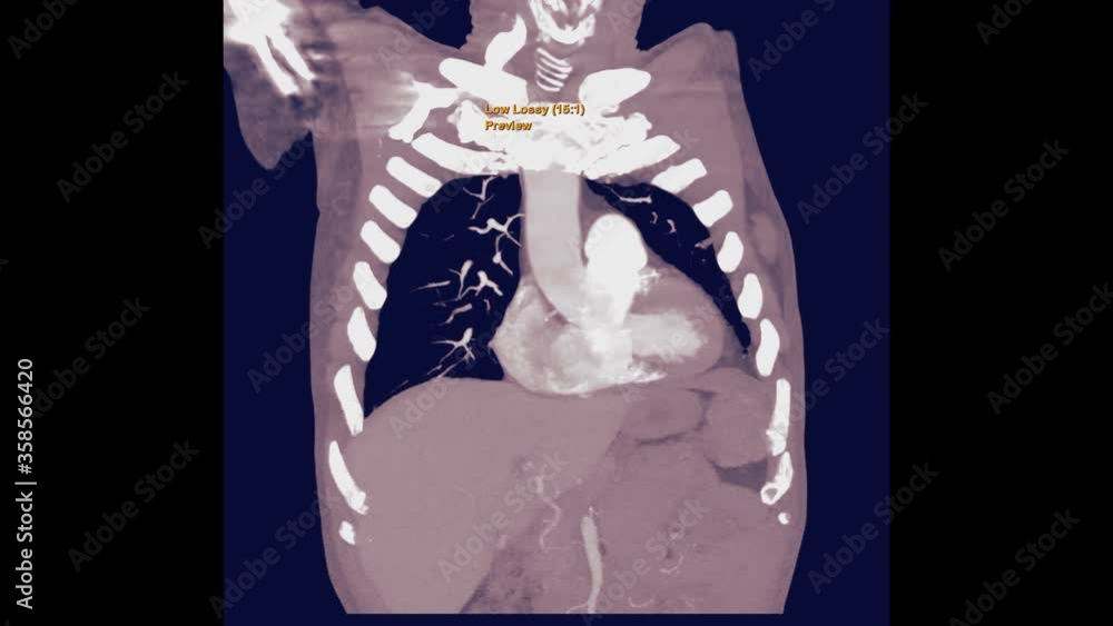 CTA for PE or pulmonary embolism , CT Chest with contrast media agent