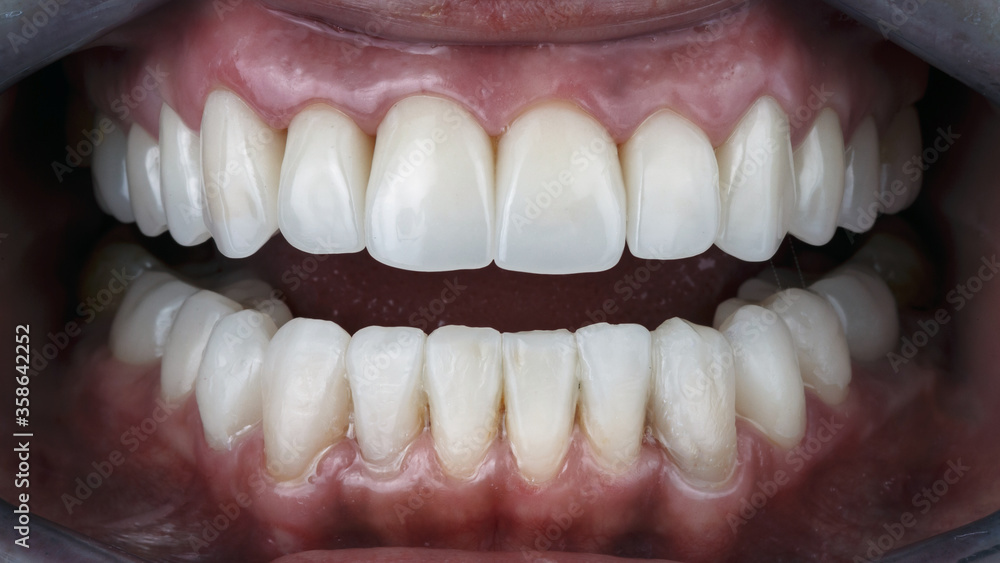 smile with ceramic veneers, dental photography smile with ceramic veneers, dental photography